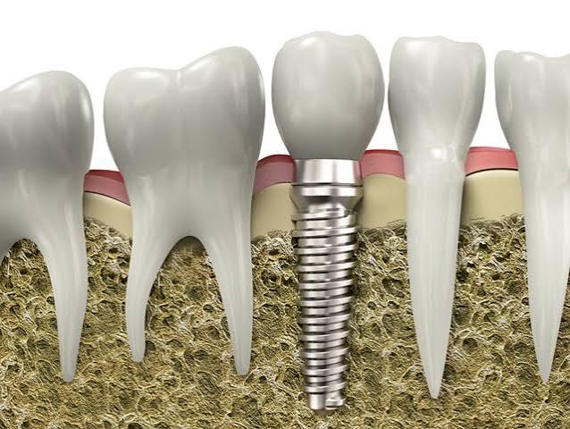 Home 37 How Much Do Dental Implants Cost in the UK in 2026?
