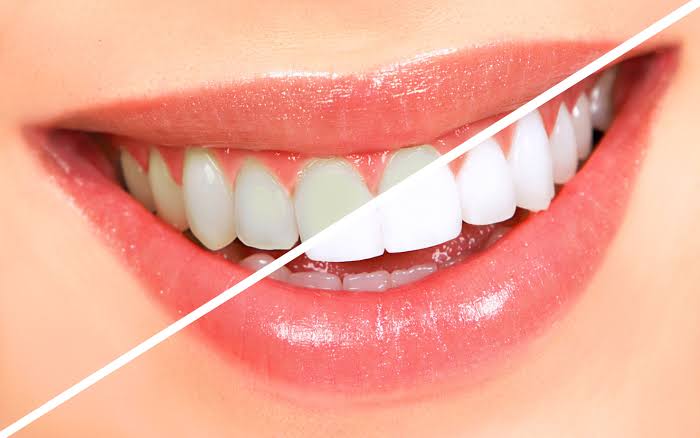 Home 36 Is Teeth Whitening Safe